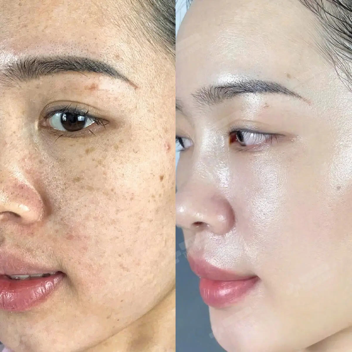 Video – Hình Ảnh Kết Quả Khách Hàng Điều Trị Nám Da