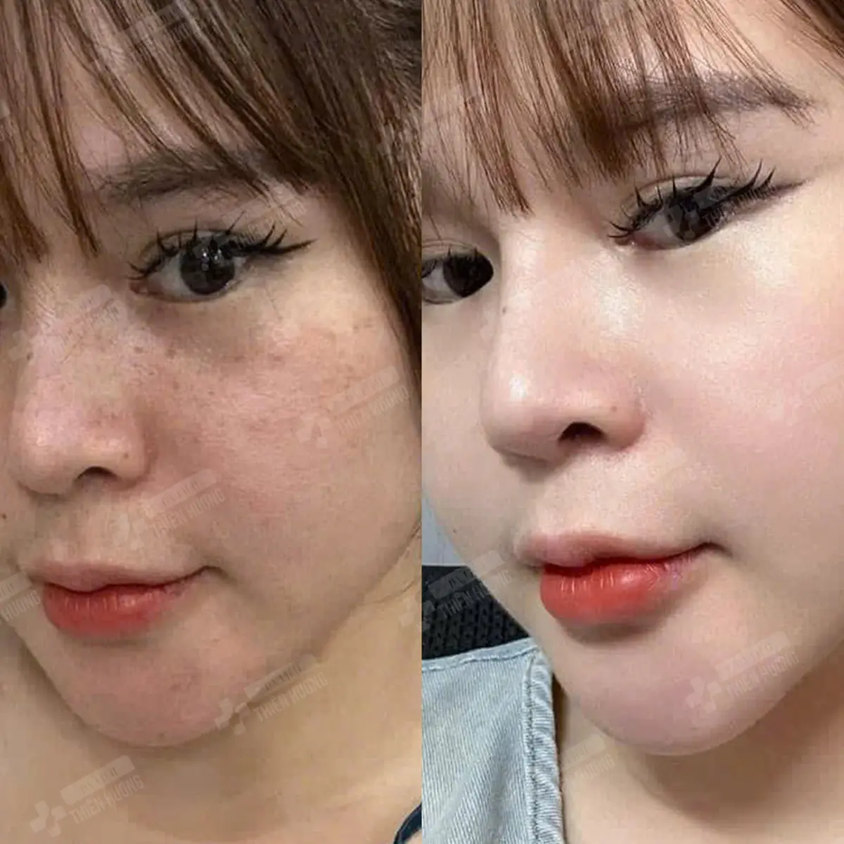 Video – Hình Ảnh Kết Quả Khách Hàng Điều Trị Nám Da