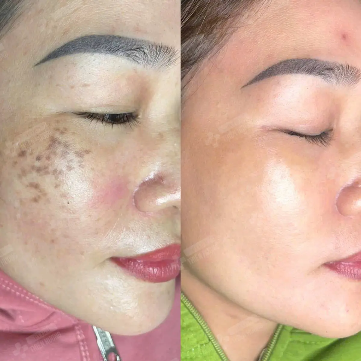 Video – Hình Ảnh Kết Quả Khách Hàng Điều Trị Nám Da