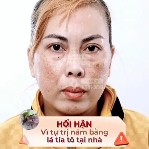 Video – Hình Ảnh Kết Quả Khách Hàng Điều Trị Nám Da
