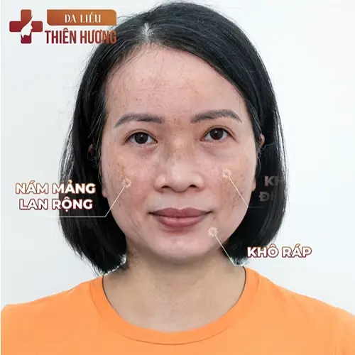 Video – Hình Ảnh Kết Quả Khách Hàng Điều Trị Nám Da