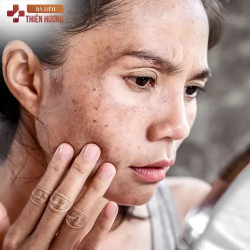Vitamin E Trị Nám Được Không? Sự Thật & Cách Dùng Đúng